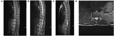 Immunoglobulin G4-Related Spinal Intramedullary Inflammatory Pseudotumor: A Case Report and Literature Review